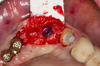 xenogenes Knochenersatzmaterial 