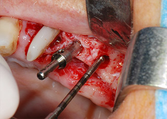 Intaktheit der Sinusmembran 