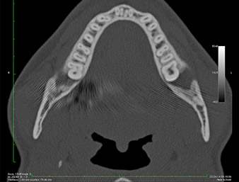 DVT-image