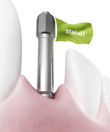 Osstell ISQ
