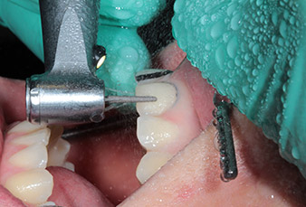 Use of electric motors for preparation of CAD/CAM treatment | W&H