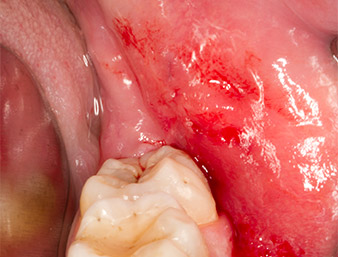sulcular incision 