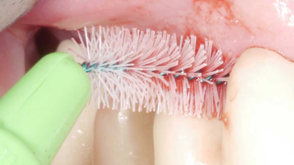 Periimplantäre Mukositis – sind chemische Zusätze effektiv?