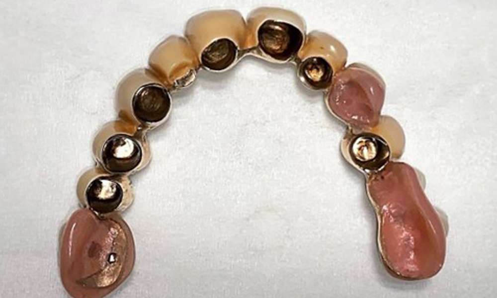 Basal view of the dentures for assessing cleanliness.