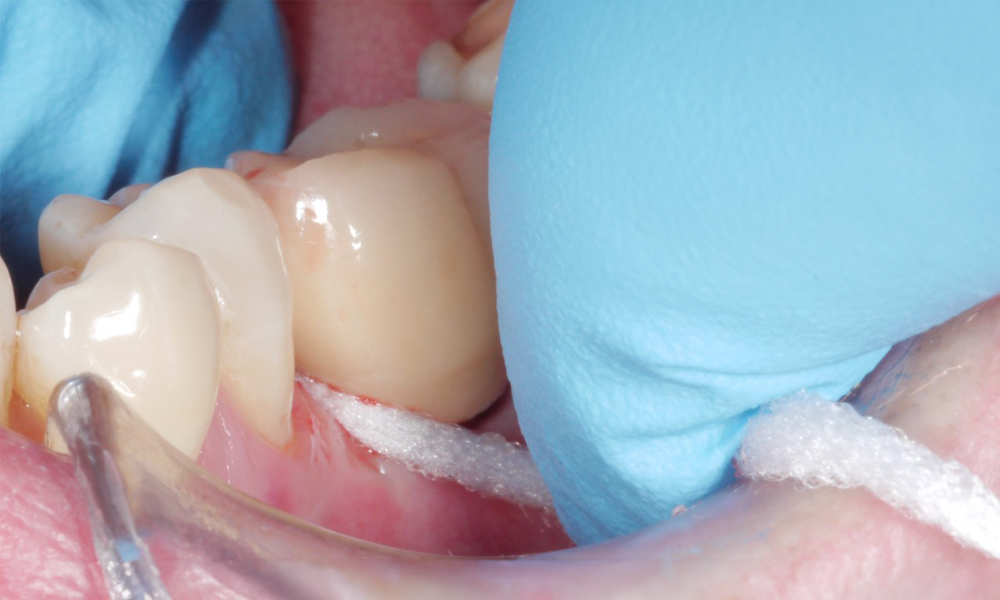 Les couronnes sur implants doivent être maintenues propres... mais comment ?