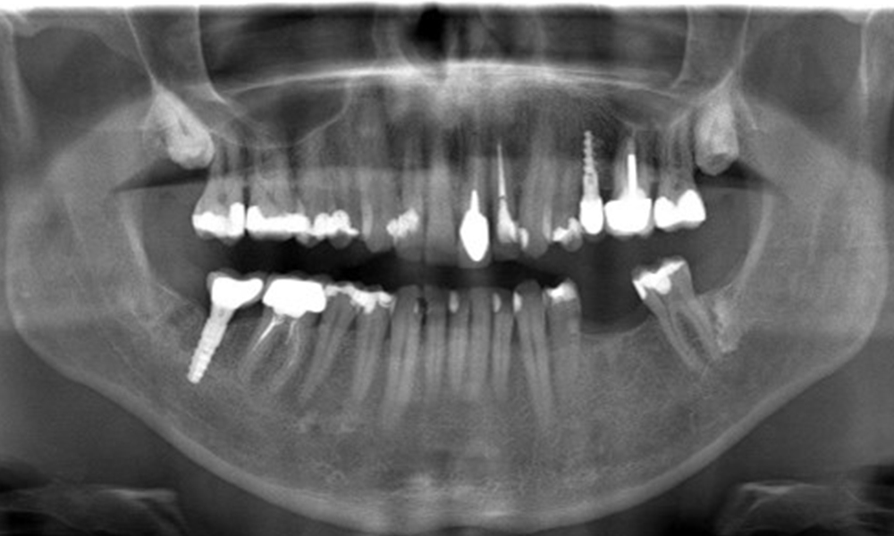 The X-ray image shows the bone loss