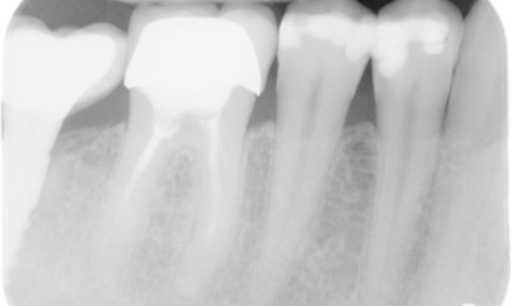 X-ray images (or bitewing X-rays)