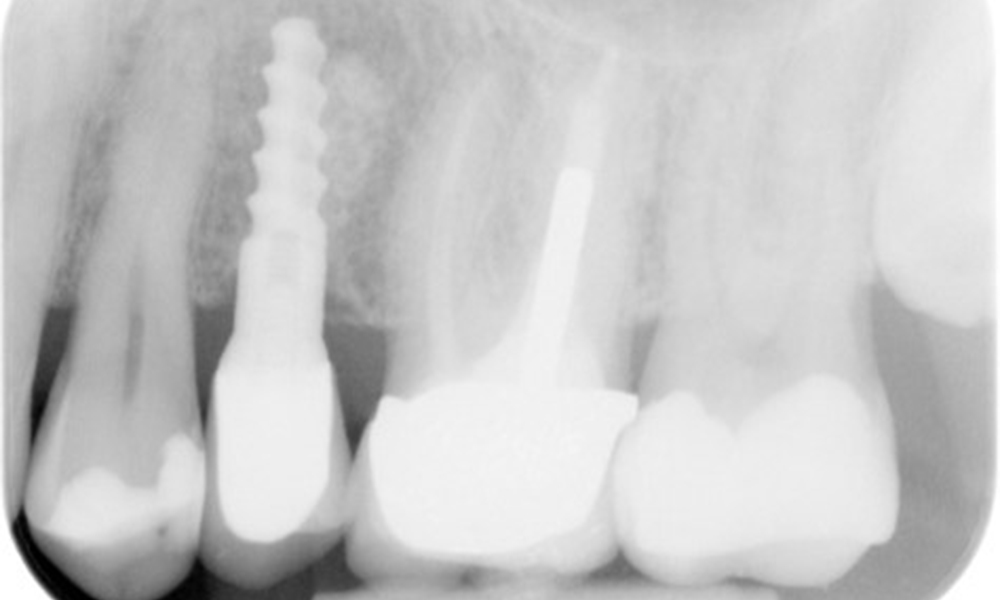 X-ray images (or bitewing X-rays)