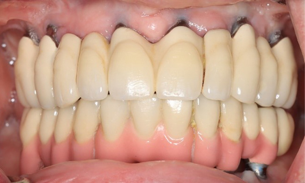 Front view of dentition (upper and lower jaw)
