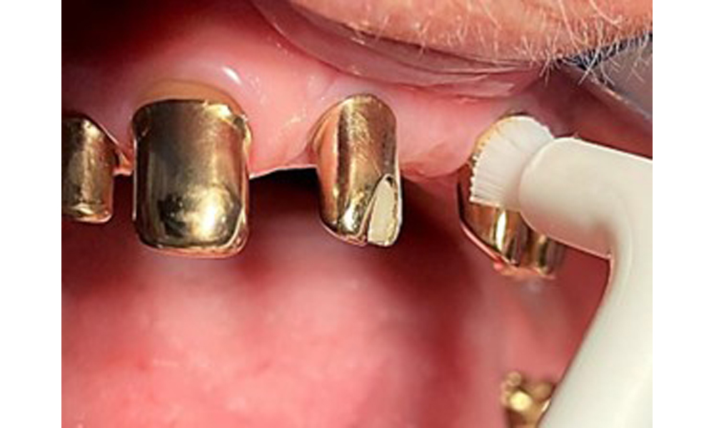 Illustration of a single-tufted brush for home care of the implants and telescopic prostheses.
