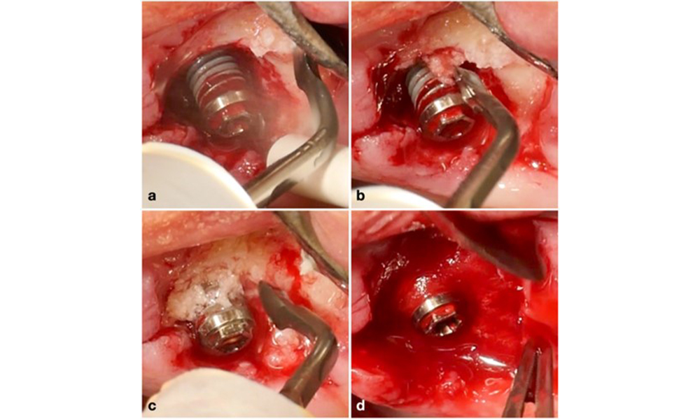 Ein Implantat mit einem primär umlaufenden intraossären Defekt (a) sollte mit einem rekonstruktiven Verfahren behandelt werden. Für die Transplantation wurde mit einem piezochirurgischen Gerät autologer Knochen gewonnen (b-c) und der Defekt wurde mit einer Kollagenmembran abgedeckt (d).