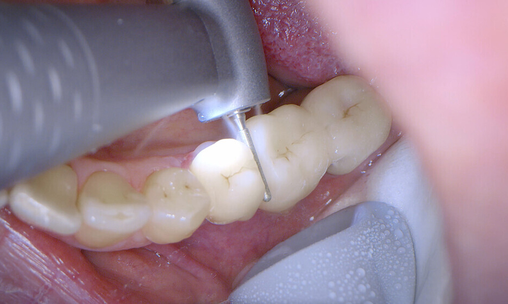 Synea Power Edition handpiece application: Cuttig and cooling.