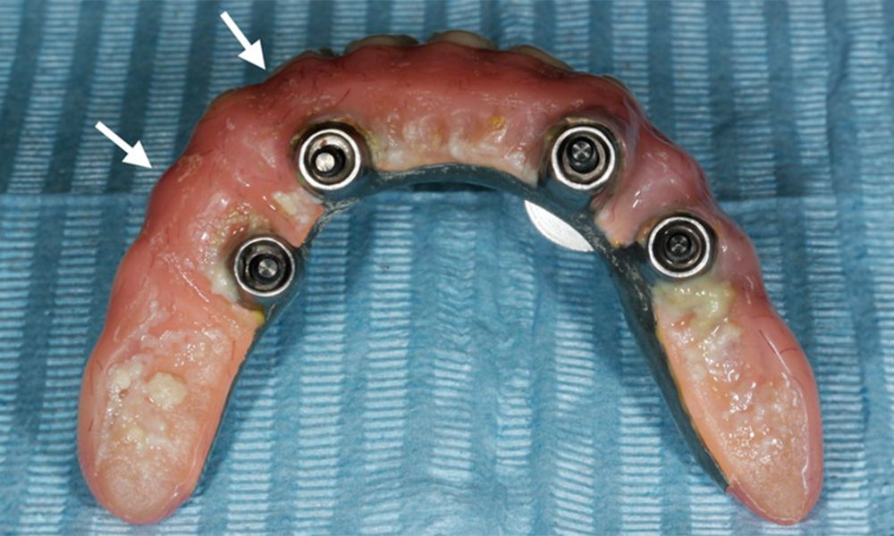 Lower jaw full-arch restoration with significant plaque accumulation due to poor oral hygiene. Notice the large distance of the buccal aspect of the prosthesis to the implants on the right side (white arrows).