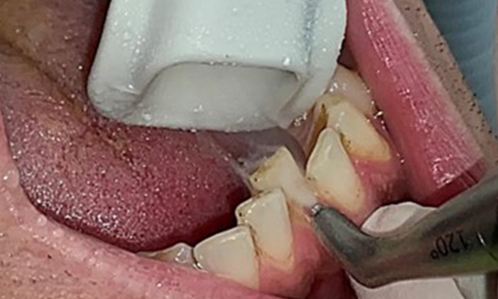 Utilisation du système de polissage à l'air loin du sulcus avec aspiration controlatérale