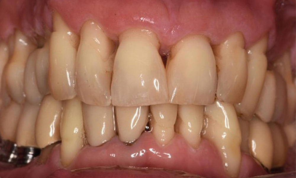 Front view of dentition (upper and lower jaw)
