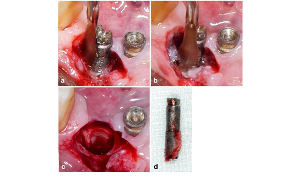  Explantation of a severely affected implant using a piezo surgery device. The implant in position 43 was part of a 4-unit bridge supported by 3 implants. Because of significant bone loss and minor relevance in the support for the bridge, treating the implant was deemed impractical. Explantation was performed with a piezo surgery device and specially designed tips (a-c) ensuring a minimal amount of bone loss (d).