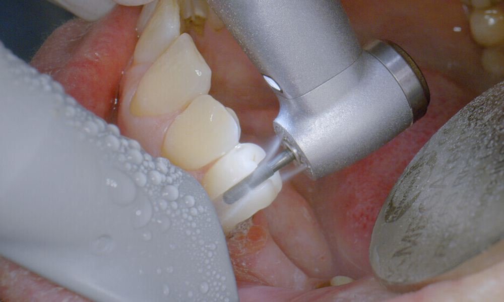 Synea Power Edition handpiece application: Cutting and cooling.