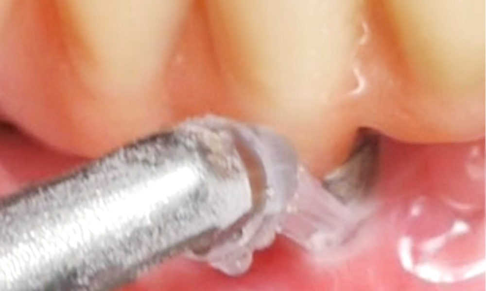 Traitement non chirurgical de la péri-implantite - standard d'or ... ?