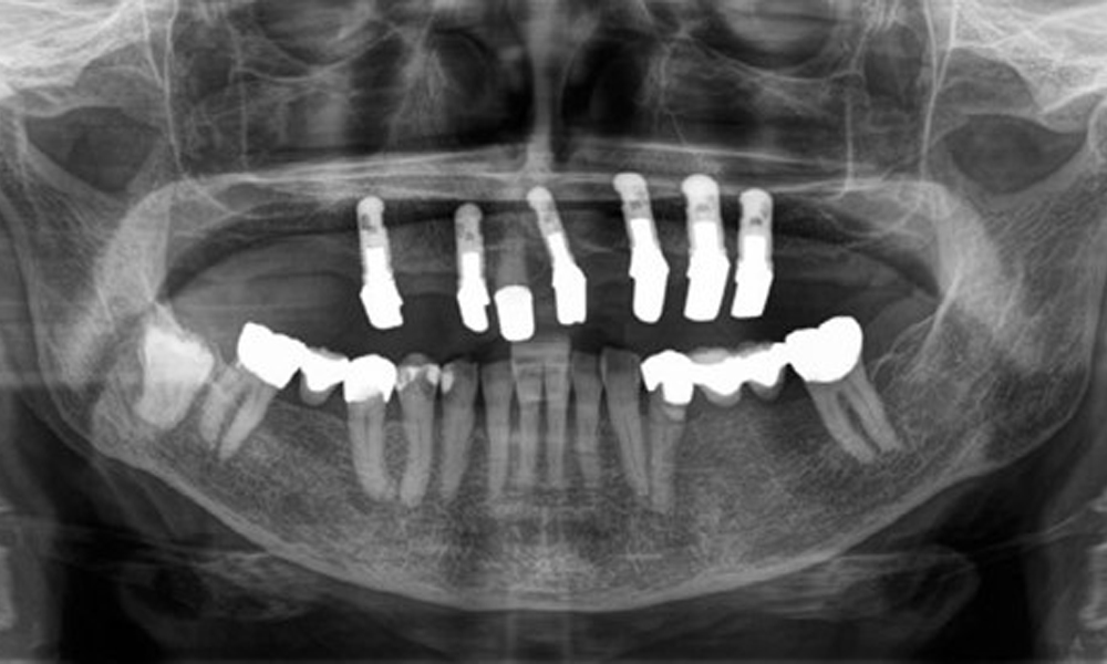 Panoramic X-ray image. The patient has a full set of adult teeth with generalised bone loss of between 10% and 30%. There is radiological suspicion of secondary caries on 44 and 43.