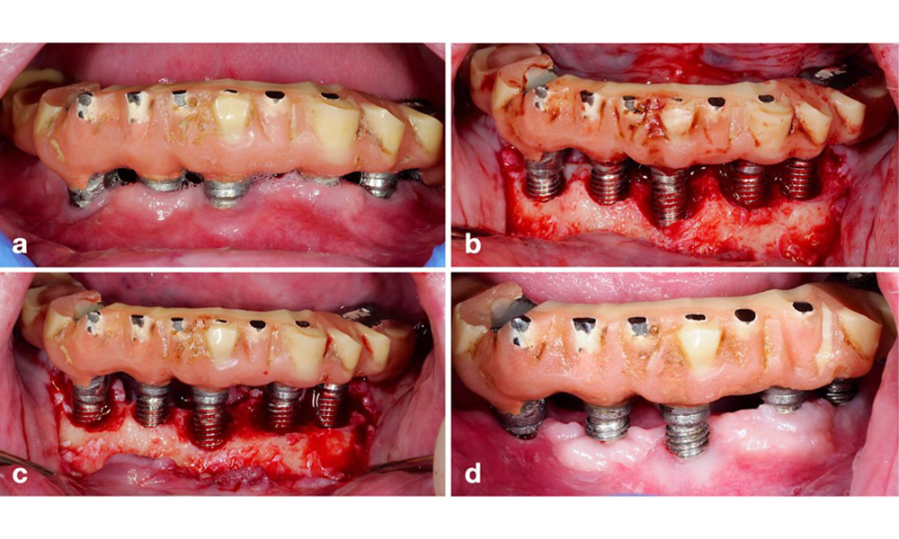 Patient treated with a resective approach (a). After flap elevation mainly horizontal bone loss is seen (b), addressed by bone re-contouring (c) and an apically displaced flap resulting in a stable post-operative result (d).