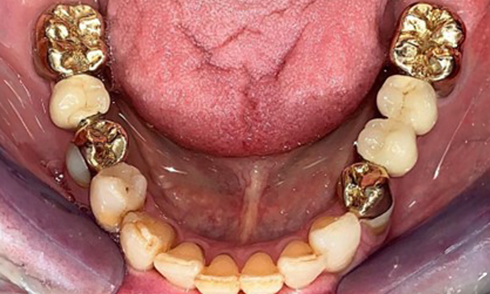 Occlusal view of the mandible.