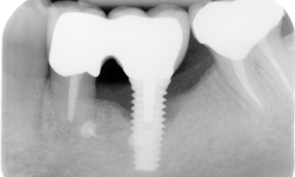 The X-ray images show the progression of bone loss.