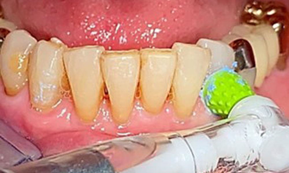 Selective polishing of tooth 33 (Proxeo Twist, W&H, shown here)