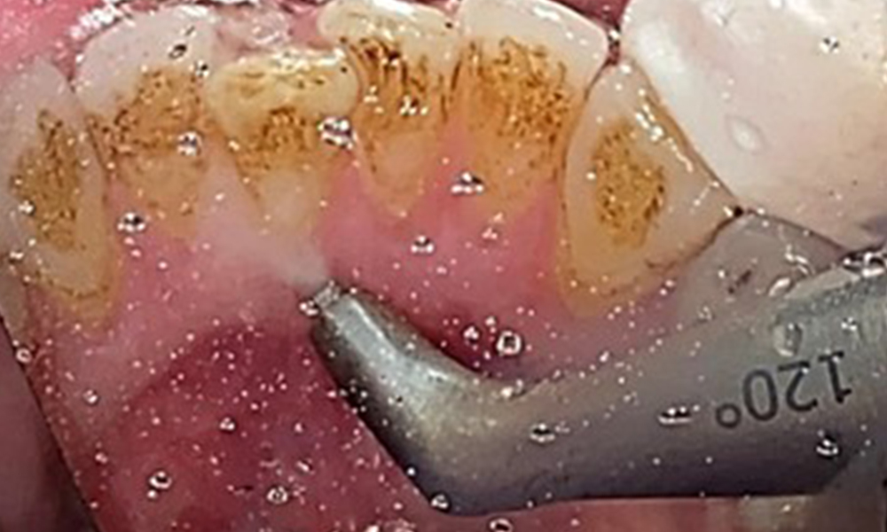 Air polishing system use in the mandibular frontal lingual area (here, Proxeo Aura, W&H)