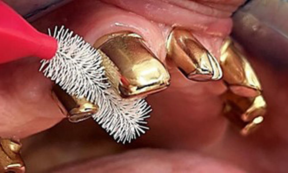 Illustration of the correct interdental brush size