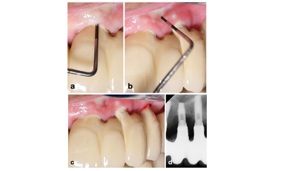 Restauration de l'arcade complète avec péri-implantite à des degrés divers sur certains implants. L'implant en position 21 est sévèrement atteint avec des profondeurs de sondage allant jusqu'à 9 mm (a), un saignement au sondage, une suppuration du sillon péri-implantaire et une fistule vestibulaire (b-c) ; la radiographie montre une perte osseuse d'environ 50 % pour l'implant atteint de péri-implantite en position 21, tandis que l'implant en position 23 présente une perte osseuse limitée, correspondant approximativement à ce que l'on peut attendre après la cicatrisation initiale pour ce type d'implants (d).