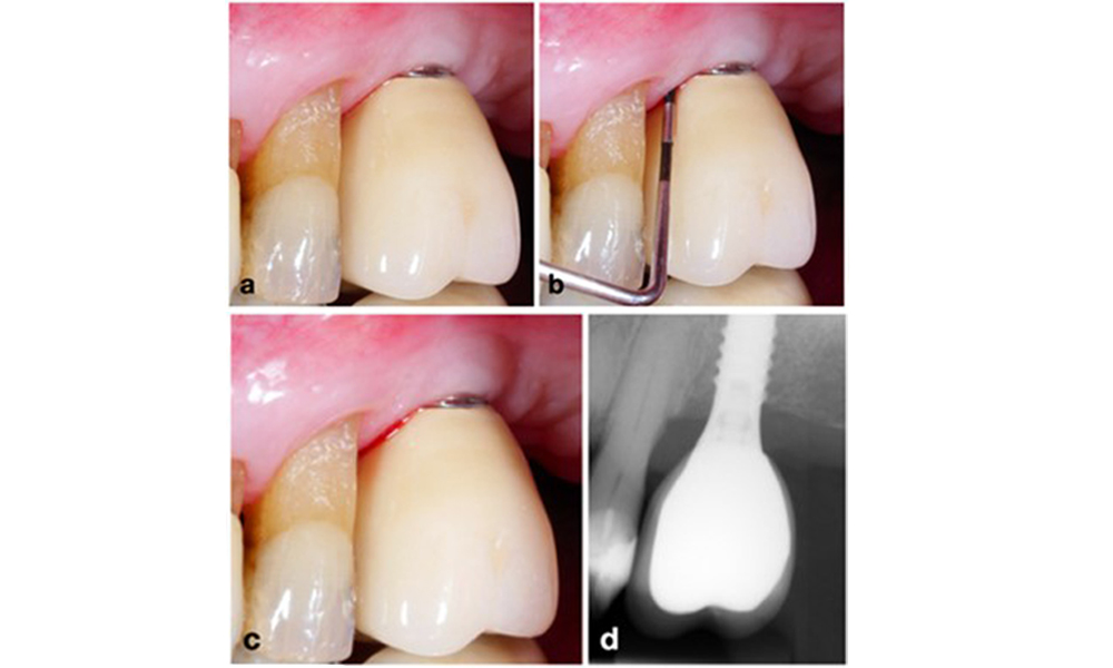 Implantat an Position 26 mit periimplantärer Mukositis (a-c). Die Sondierungstiefe von 5 mm (b) stimmt mit der wenige Wochen nach dem Einsetzen der prothetischen Rekonstruktion vorgenommenen Messung überein. Es kommt zwar zu einer Sondierungsblutung (c), aber die Röntgenaufnahme zeigt keinen weiteren Knochenverlust über das Maß hinaus, das bei einer marginalen Knochen-Remodellierung zu erwarten ist (d).