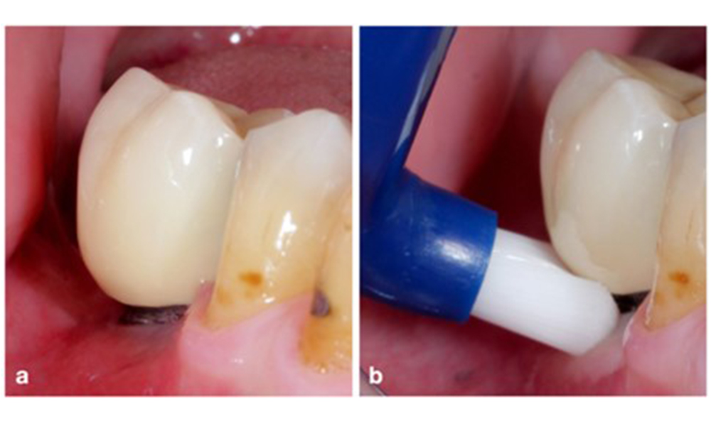 Oral hygiene instructions. Patients should be instructed in detail in how to efficiently clean the implant restoration, considering variations in crown form and shape compared to natural dentition. A buccal overhang (a) might require a single tufted toothbrush in addition to the regular toothbrush (b).