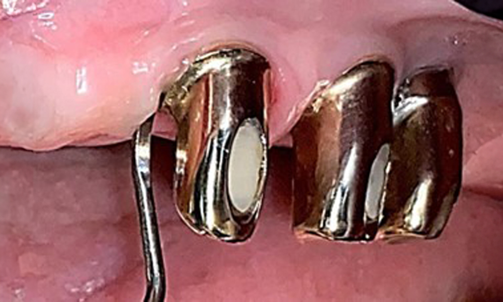 Processing the implant surface with manual titanium instruments.