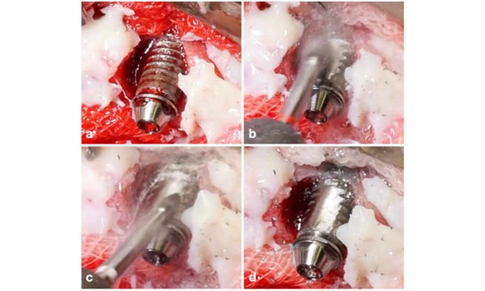 Pour les implants dont la surface est modifiée dans les zones où la régénération osseuse est limitée, l'implantoplastie doit être envisagée. Dans un cas de déhiscence buccale, l'aspect buccal de la surface modifiée de l'implant (a) a fait l'objet d'une implantoplastie (b-d), les tissus environnants étant couverts pour minimiser la contamination par les particules de titane, à l'aide d'une gaze et d'une digue en caoutchouc liquide.