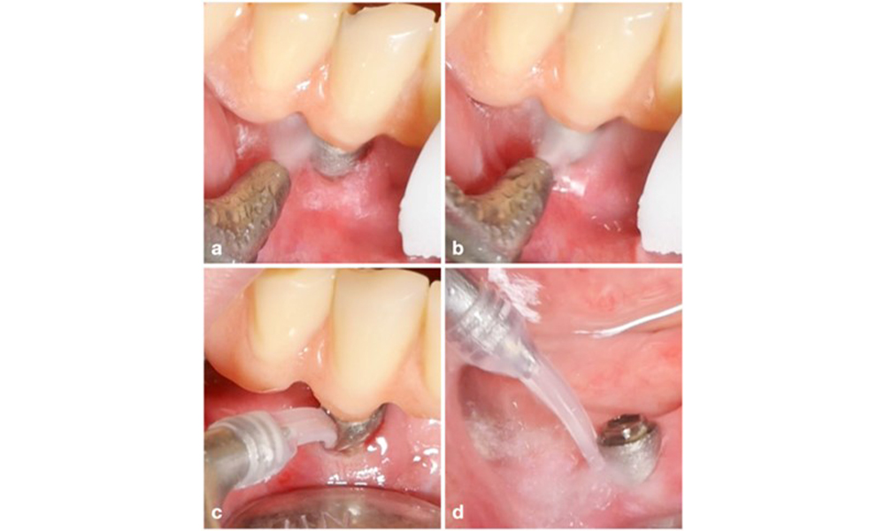 Patient case with peri-implantitis. The non-surgical treatment is performed by using the supragingival (a-b) and subgingival handpiece of an air-polishing device (c-d). Removing the supra-construction provides better access to the implant surface (d).