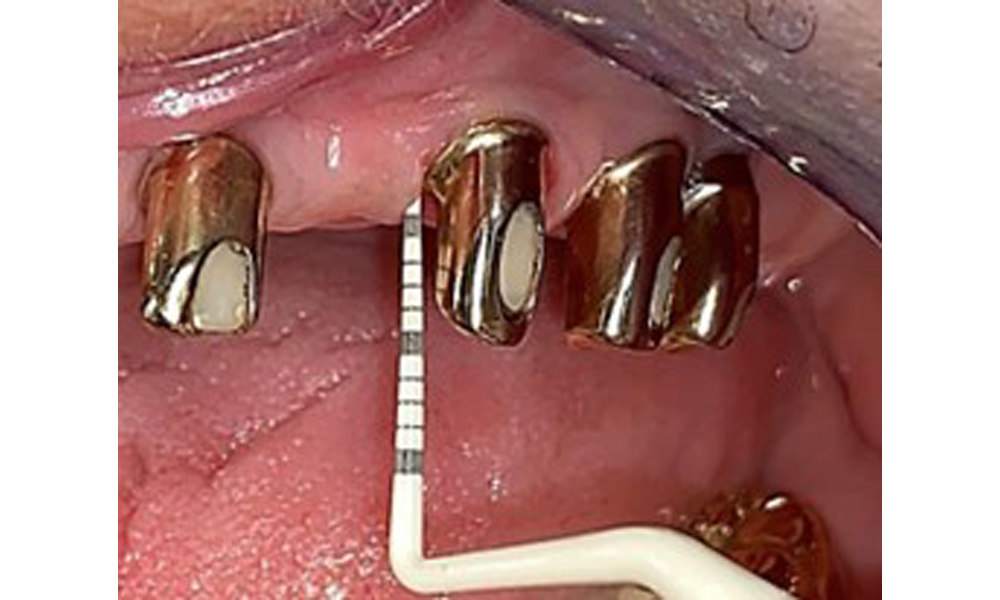 Probing implant 23 at a probing depth of 4 mm using a plastic probe, showing negative BOP findings and a hyperplastic papilla.