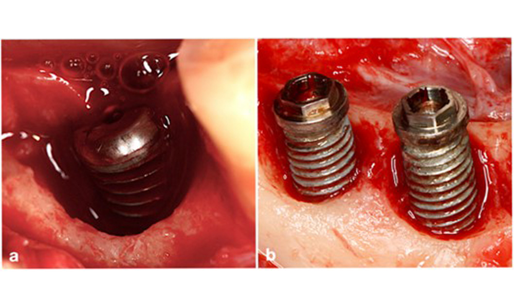 Defect morphology is one of the parameters defining the type of surgical intervention. While circumferential intrabony defects (a) can be treated well with a reconstructive approach, primarily horizontal bone defects (b) require a more resective approach.