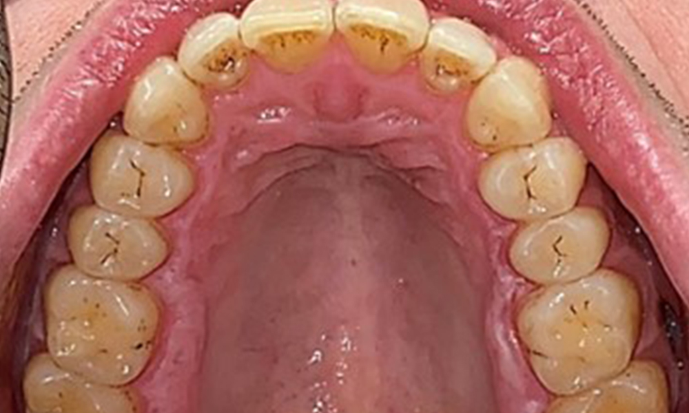 Occlusal view of the maxilla.