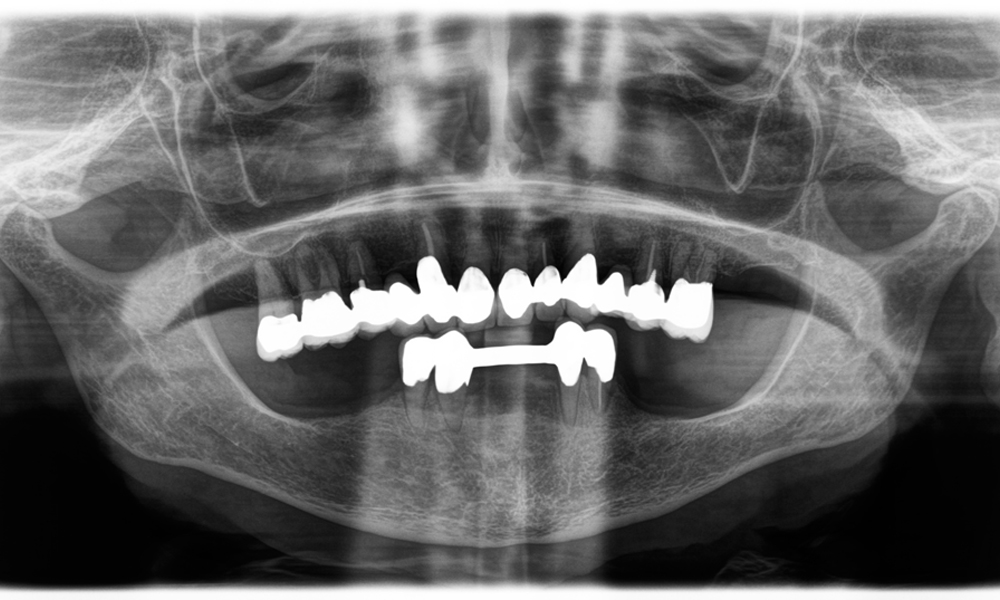 A jaw x-ray from an 81-year-old patient, in front of a black background.