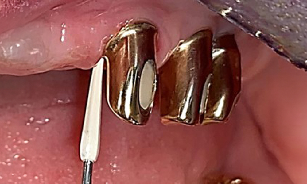 Illustration of a PEEK ultrasonic tip (Proxeo Ultra, W&H, shown here) for processing implant surfaces with mineralized plaque (no mineralized plaque was observed in the present case, this is a schematic illustration).