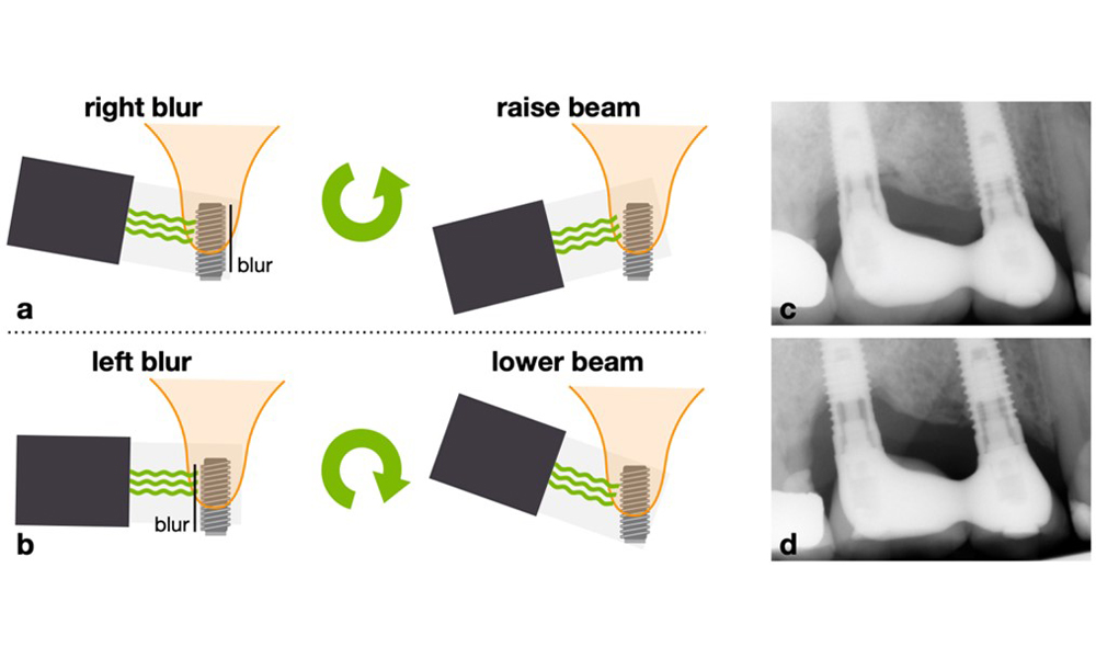 Pour obtenir des radiographies intra-orales optimales des implants dentaires, suivez cette règle mnémotechnique : si le côté droit de l'implant apparaît flou sur la radiographie péri-apicale, élevez le faisceau (c'est-à-dire dirigez-le davantage vers le plafond) (a) ; si le côté gauche apparaît flou, abaissez le faisceau (c'est-à-dire dirigez-le davantage vers le sol) (b). Cette règle s'applique quelle que soit la position de l'implant dans la mâchoire supérieure ou inférieure. Exemple : Des filets flous sur les implants en positions 14 et 16, principalement sur leur côté droit, (c) ont été corrigés en élevant le faisceau d'environ 15 degrés, ce qui a permis d'obtenir une image claire montrant le contact entre l'os et l'implant (d).