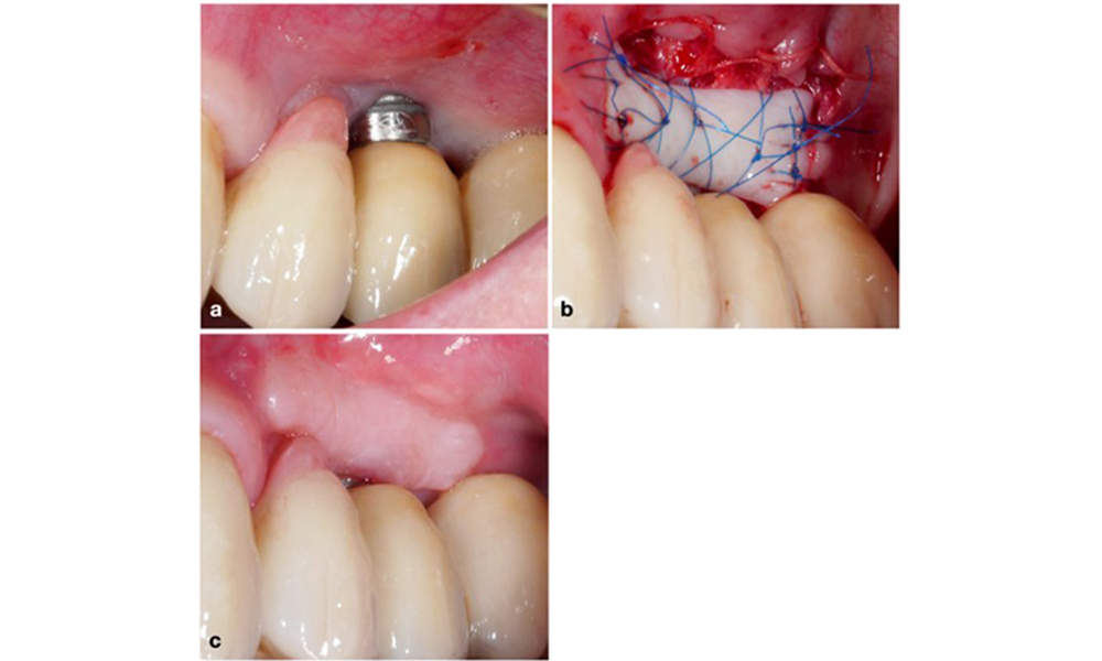 Implant dépourvu de muqueuse kératinisée au niveau de la face buccale (a). Pour augmenter la largeur de la muqueuse kératinisée, une greffe gingivale a été mise en place (b), améliorant l'efficacité de l'hygiène bucco-dentaire (c).