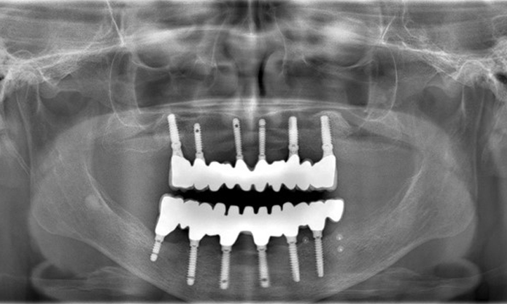 The radiographic images reveal bone resorption.