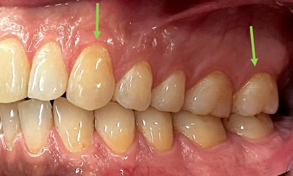 Стрелките показват натрупвания на плака в областта на шийката