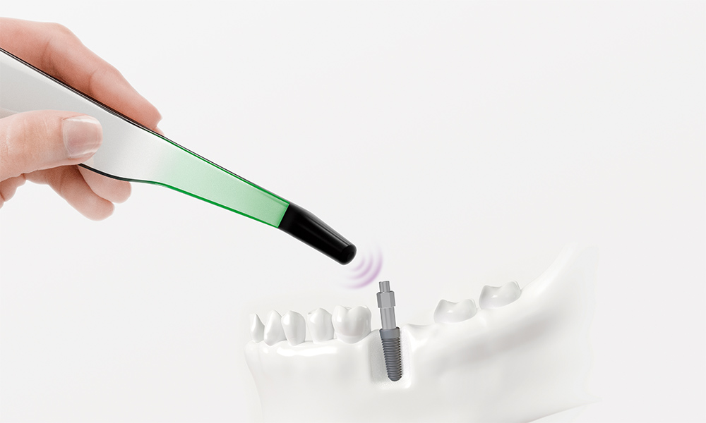 Osstell Beacon measuring on single-use SmartPeg in a prothesis.