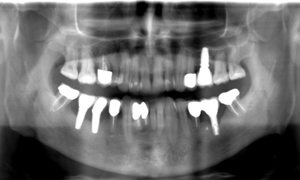 The X-ray images show the progression of bone loss.