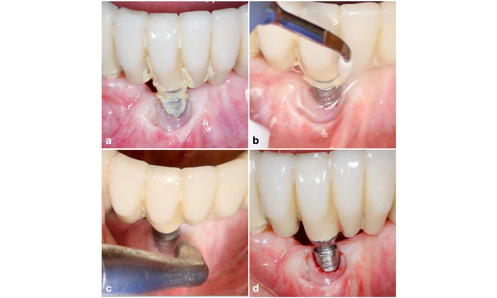 Patientenfall mit periimplantärer Mukositis, mangelnder Oralhygiene und Zahnstein (a). In einem solchen Fall ist eine Kombination unterschiedlicher Geräte ratsam. Beispielsweise sind Ultraschallscaler mit speziell geformter Spitze zum Entfernen des Zahnsteins erforderlich (b), während der restliche weiche Biofilm mit einem Luftpoliergerät entfernt werden kann (c-d).