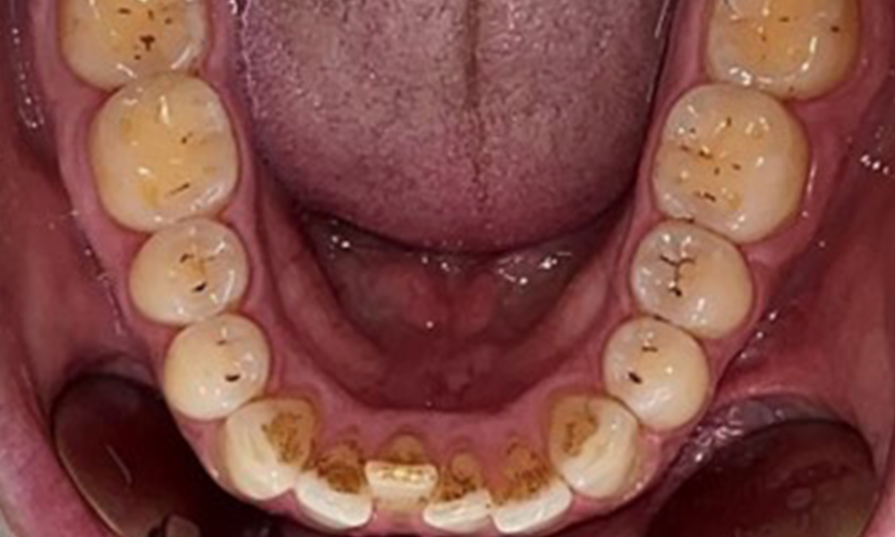 Occlusal view of the mandible.