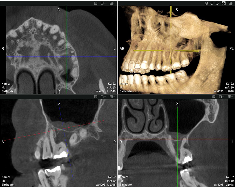 Präzise Bildgebung mit Seethrough Max: Das Röntgenbild zeigt die Schwellung der Schleimhaut im Sinus maxillaris.
