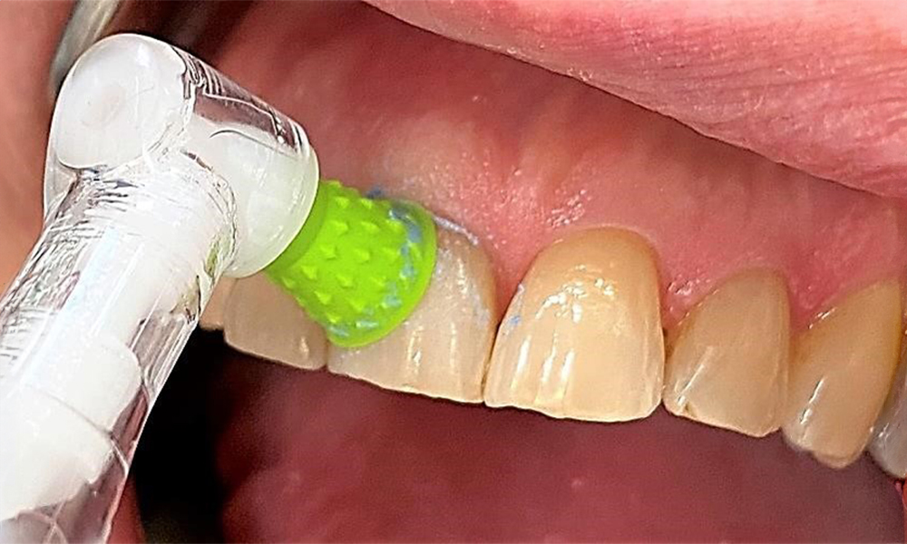 Rotierendes Polieren (hier Proxeo Cordless, W&H) unterstützt durch die schonende Glättung der Oberflächen das optimale Finish der Prophylaxe. Mittels speziell-designter Polieraufsätze kann das Spritzen der Paste minimiert werden. © Dr. R. Krapf